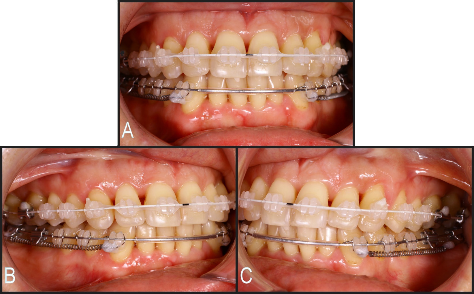 Application of the elastics from the screws to the mandibular teeth.