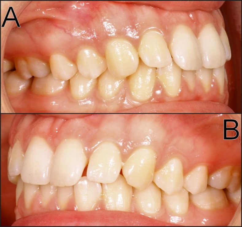 Characteristics Of Static And Excursive Occlusal Parameters In Subjects