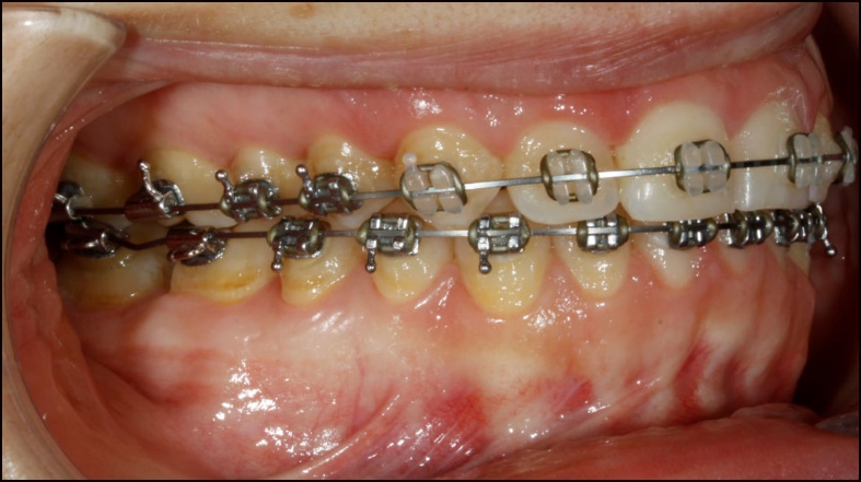 My Last Braces Checkup - Bending orthodontic wire - Tooth Time