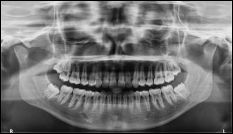 Icd 9 X Ray Temporomandibular Joint